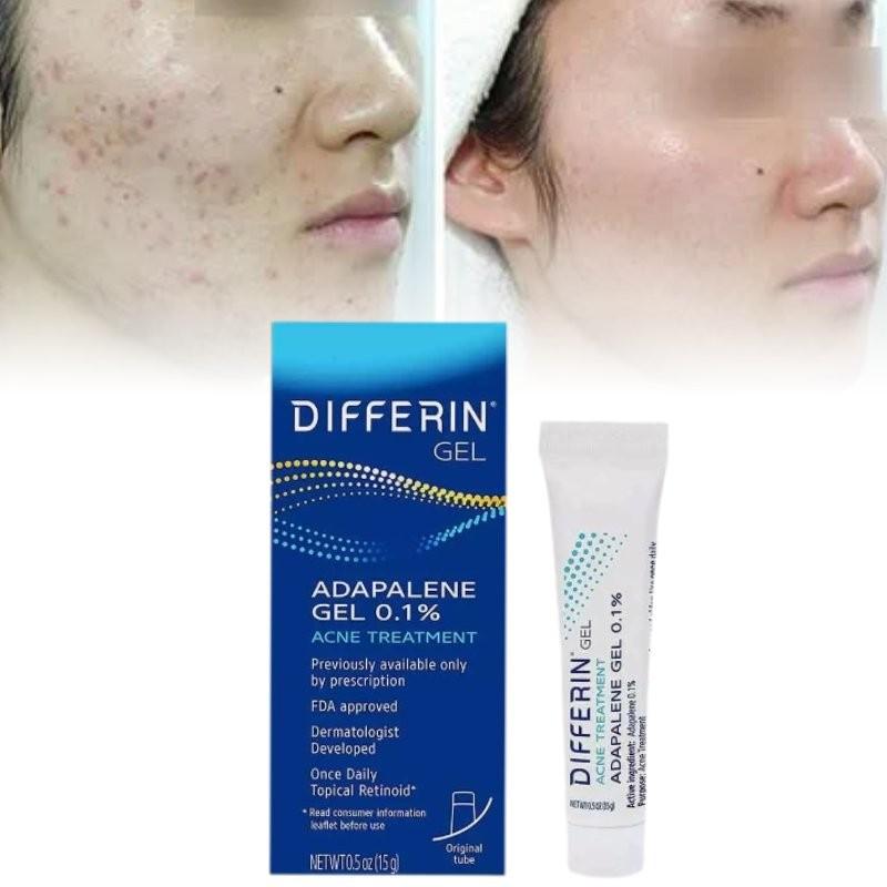 Differin Acne Treatment Gel Retinoid Gel For Clear Radiant Skin 15g