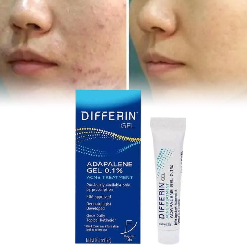 Differin Acne Treatment Gel Retinoid Gel For Clear Radiant Skin 15g