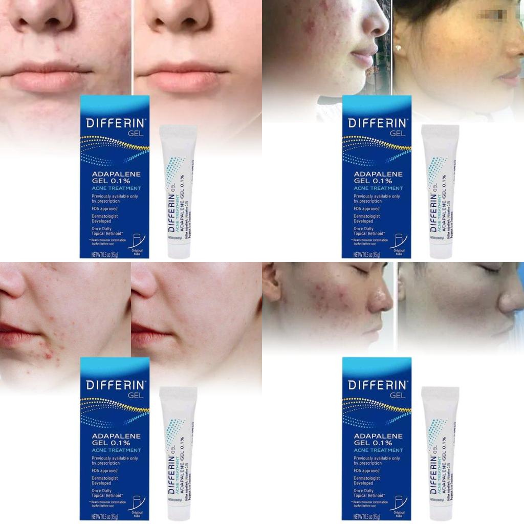 Differin Acne Treatment Gel Retinoid Gel For Clear Radiant Skin 15g