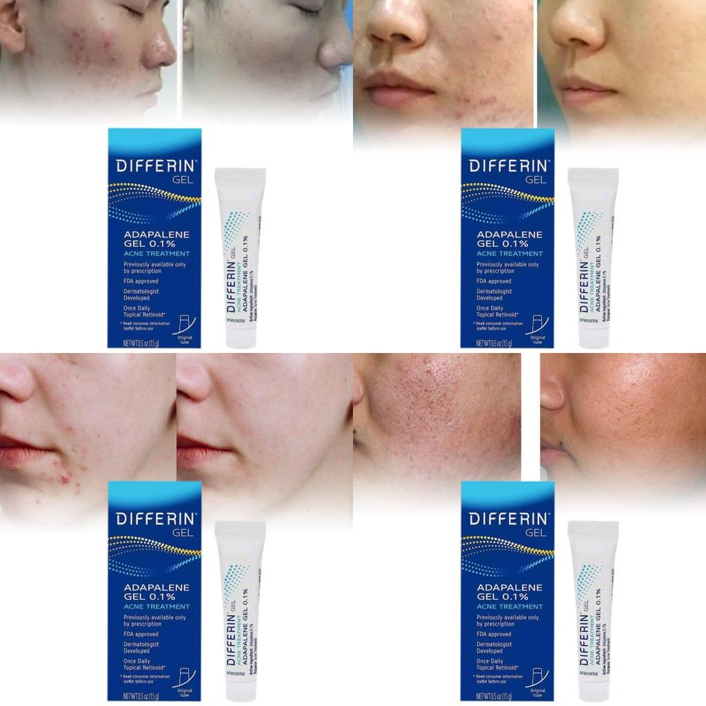 Differin Acne Treatment Gel Retinoid Gel For Clear Radiant Skin 15g