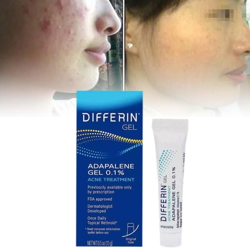 Differin Acne Treatment Gel Retinoid Gel For Clear Radiant Skin 15g